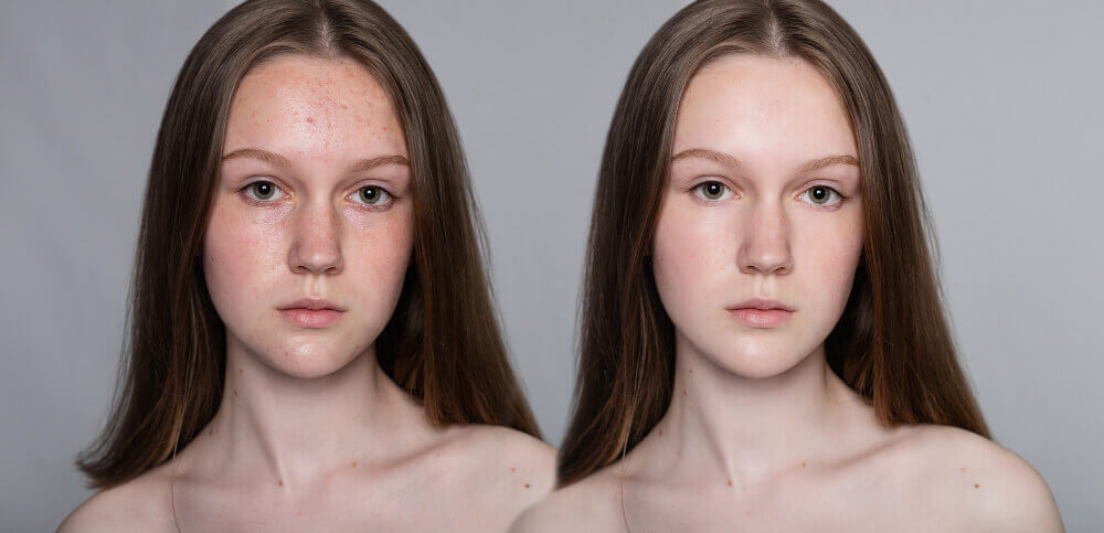 Slika prikaže prej in pol sliko kako se akne odstranijo in koža očisti.