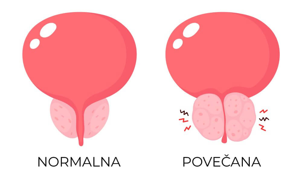 CBG in prostata 1