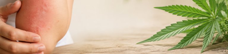 Dermatitis in luskavica: Ali konoplja lajša vnetne kožne bolezni